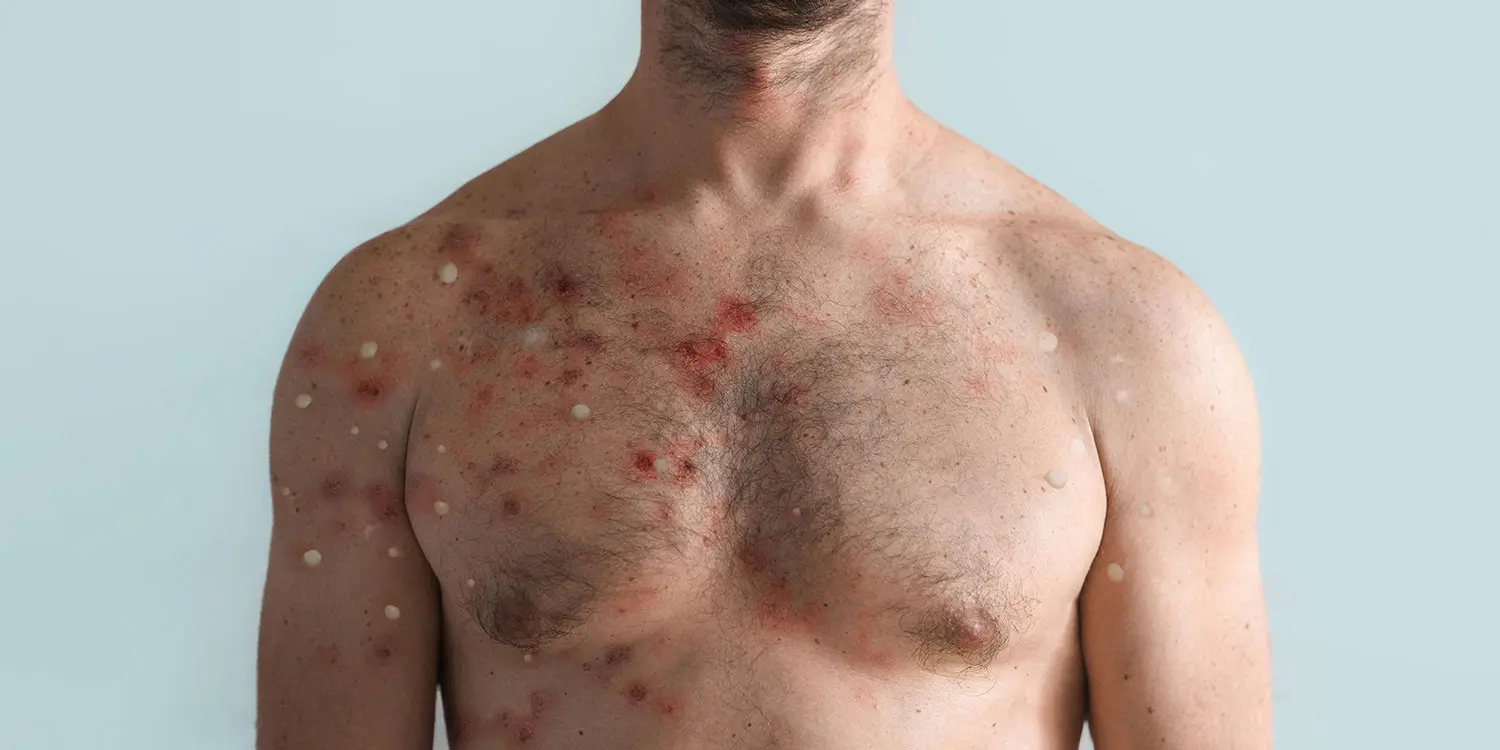 Mpox-Fälle erstmals in Nordmazedonien bestätigt